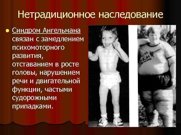 Нетрадиционное наследование l Синдром Ангельмана связан с замедлением психомоторного развития, отставанием в росте головы,