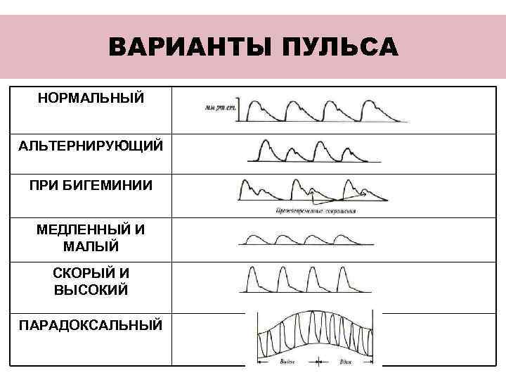 Схема альтернирующего пульса основные характеристики