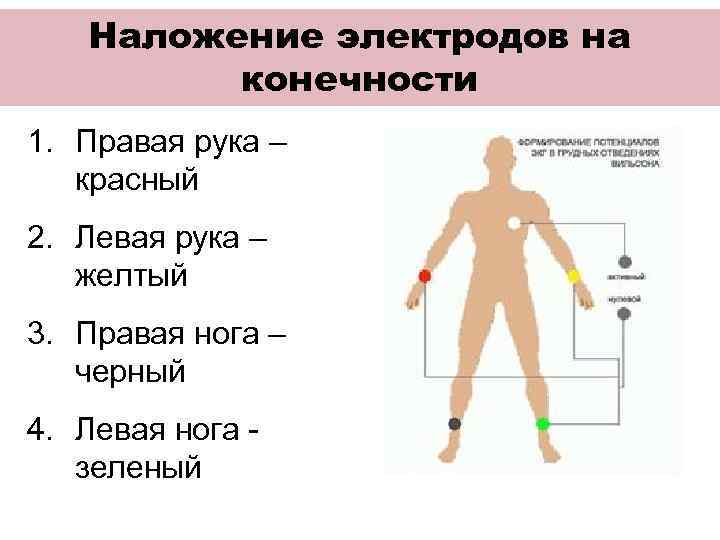 Наложение электродов при экг по цветам на конечности фото