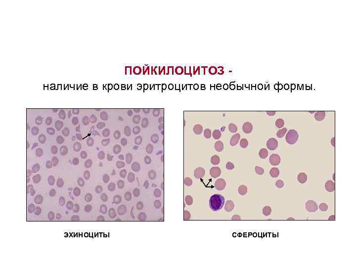 ПОЙКИЛОЦИТОЗ наличие в крови эритроцитов необычной формы. эхиноциты ЭХИНОЦИТЫ сфероциты СФЕРОЦИТЫ 