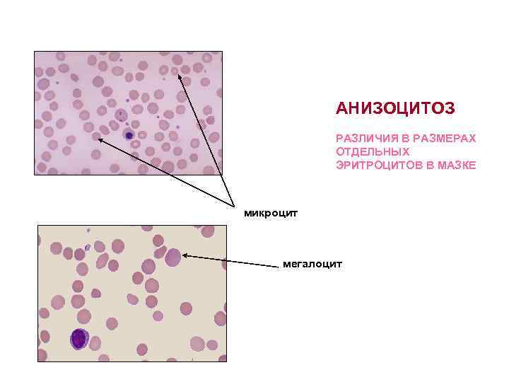 АНИЗОЦИТОЗ РАЗЛИЧИЯ В РАЗМЕРАХ ОТДЕЛЬНЫХ ЭРИТРОЦИТОВ В МАЗКЕ микроцит мегалоцит 