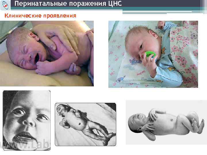 Перинатальные поражения ЦНС Клинические проявления 
