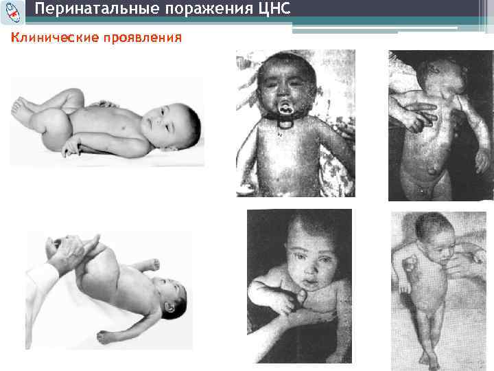 Перинатальные поражения ЦНС Клинические проявления 