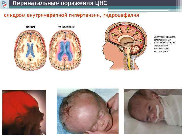 Перинатальные поражения ЦНС синдром внутричерепной гипертензии, гидроцефалия 