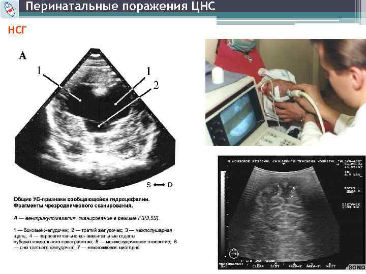 Перинатальные поражения ЦНС НСГ 