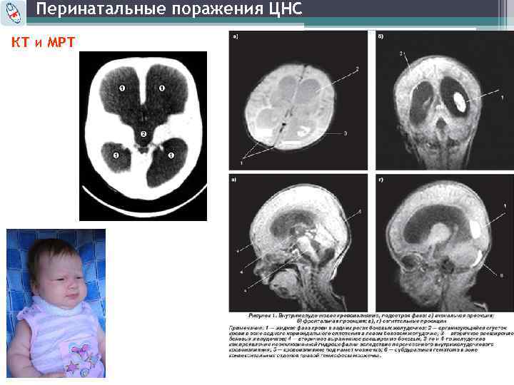 Перинатальные поражения ЦНС КТ и МРТ 