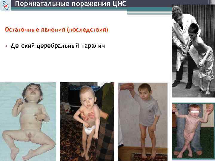 Перинатальные поражения ЦНС Остаточные явления (последствия) • Детский церебральный паралич 