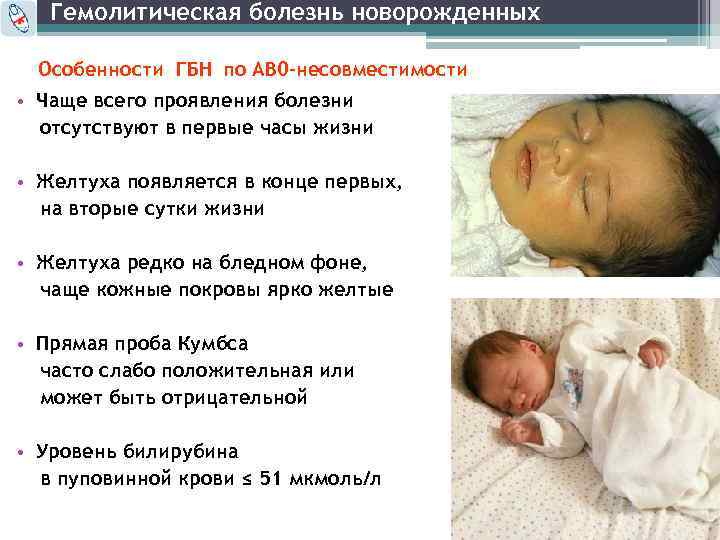 Почему новорожденных умирают. Гемолитическая болезнь новорожденных. Гемолитическая болезнь новорожденного. Отечная форма гемолитической болезни плода. Желтушная форма гемолитической болезни новорожденных.