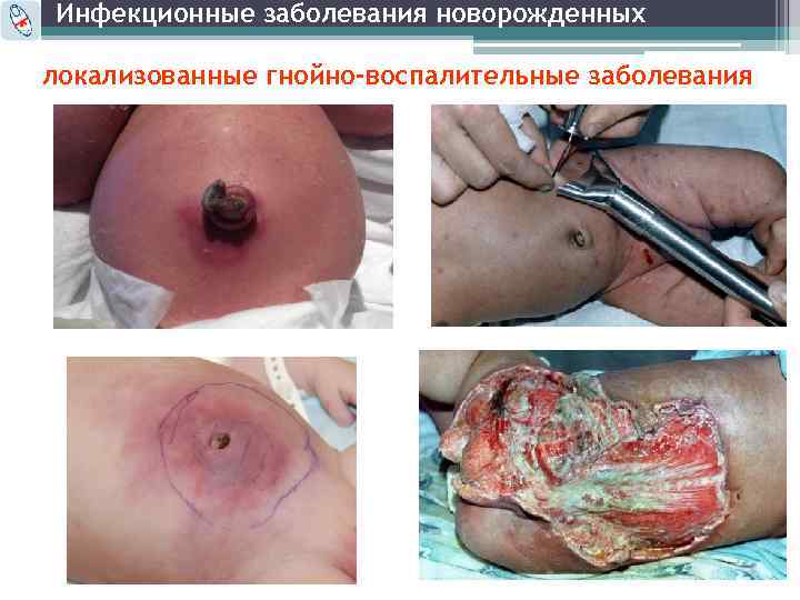 Инфекционные заболевания новорожденных локализованные гнойно-воспалительные заболевания 