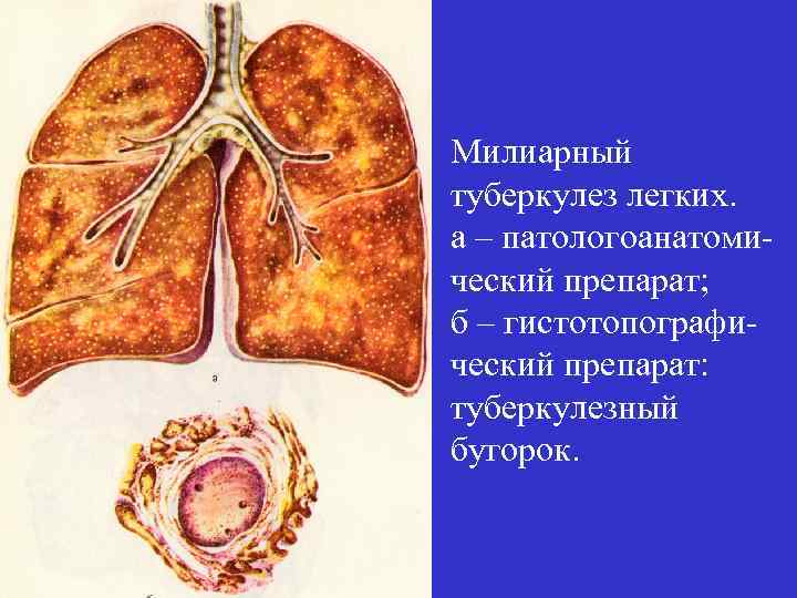 Презентация туберкулез мочевыделительной системы