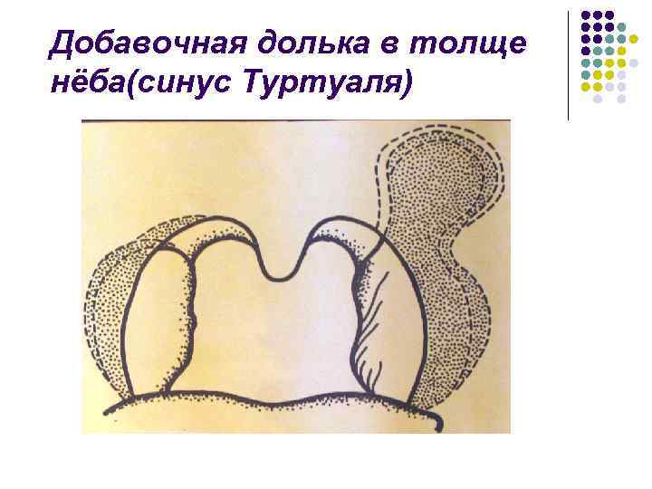 Добавочная долька в толще нёба(синус Туртуаля) 