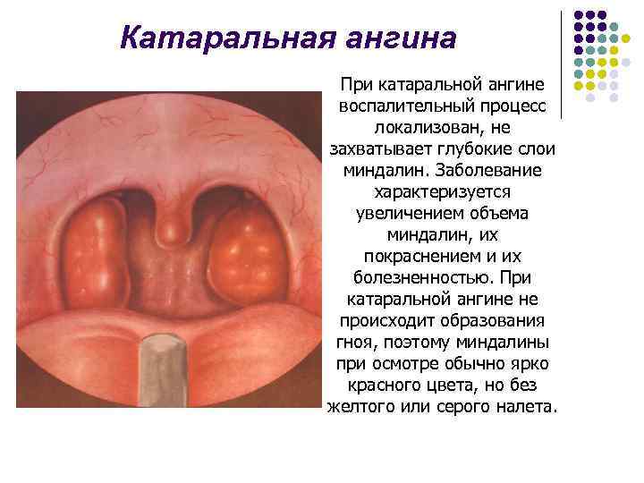 Катаральная ангина При катаральной ангине воспалительный процесс локализован, не захватывает глубокие слои миндалин. Заболевание