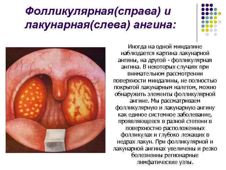 Фолликулярная(справа) и лакунарная(слева) ангина: Иногда на одной миндалине наблюдается картина лакунарной ангины, на другой