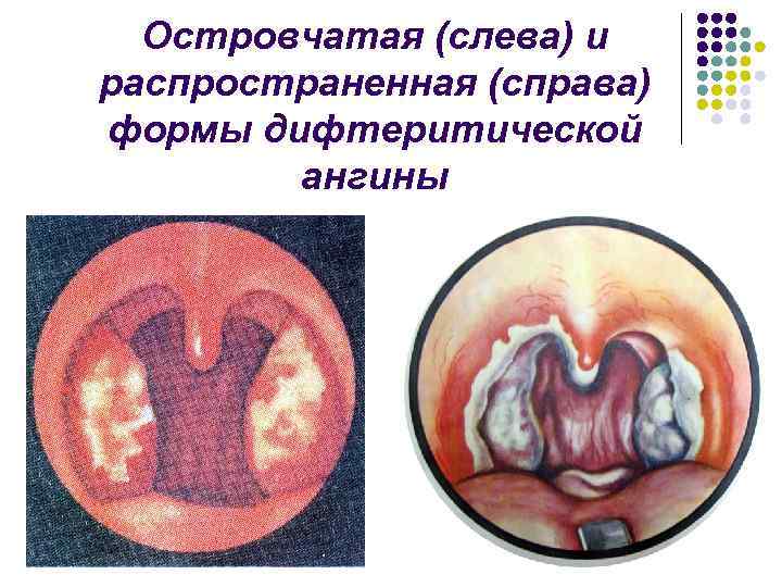 Островчатая (слева) и распространенная (справа) формы дифтеритической ангины 