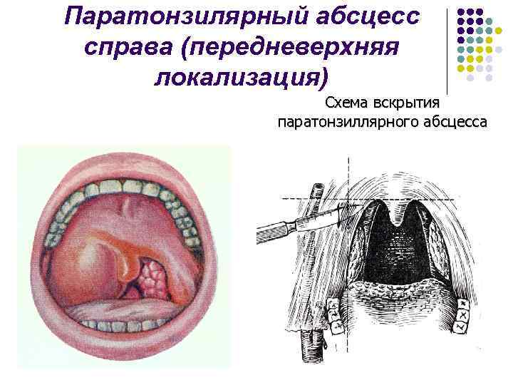 Паратонзилярный абсцесс справа (передневерхняя локализация) Схема вскрытия паратонзиллярного абсцесса 