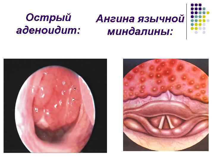 Острый аденоидит: Ангина язычной миндалины: 