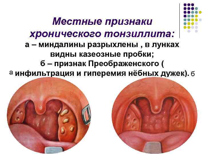 Местные признаки хронического тонзиллита: а – миндалины разрыхлены , в лунках видны казеозные пробки;