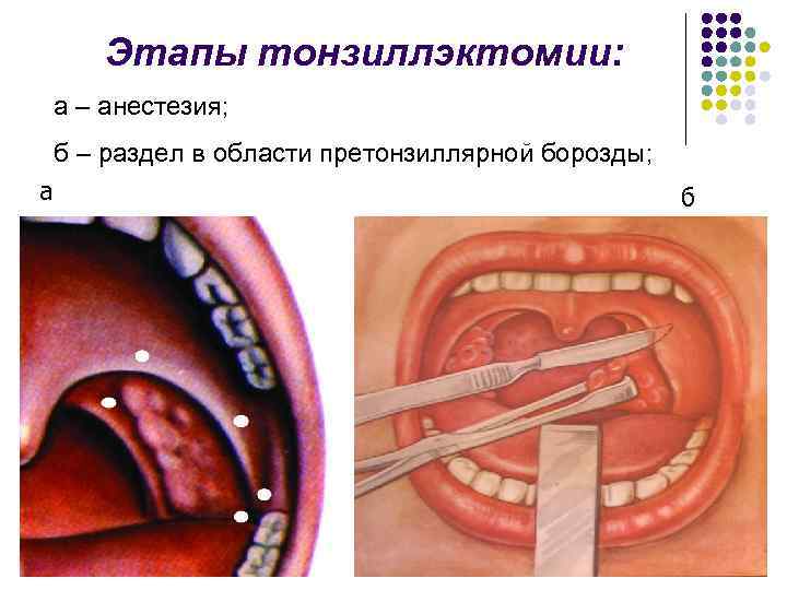 Этапы тонзиллэктомии: а – анестезия; б – раздел в области претонзиллярной борозды; а б