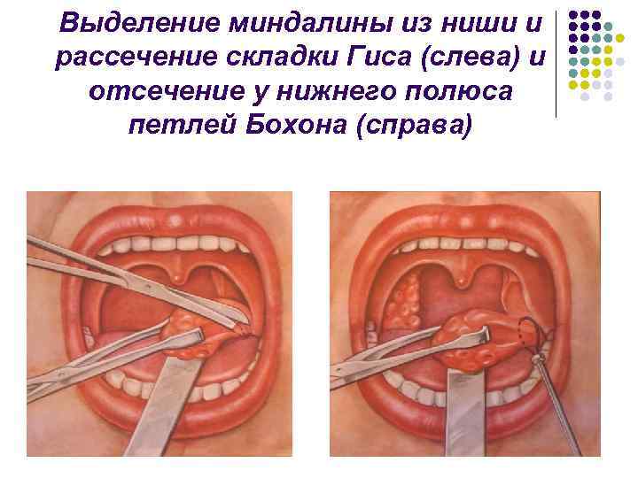 Выделение миндалины из ниши и рассечение складки Гиса (слева) и отсечение у нижнего полюса
