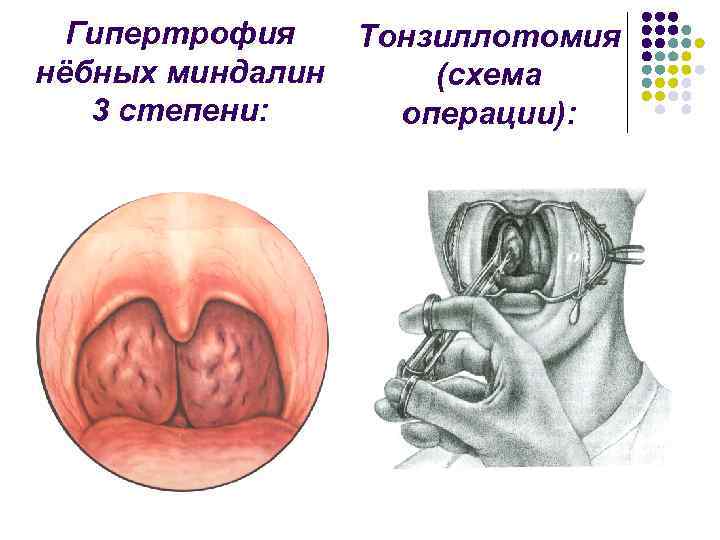 Гипертрофия нёбных миндалин 3 степени: Тонзиллотомия (схема операции): 