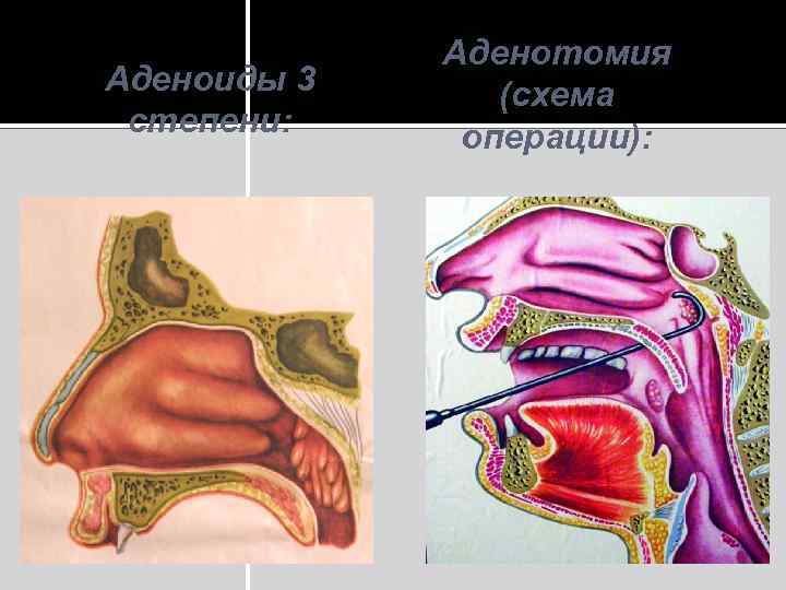 Лазер при аденоидах у детей схема