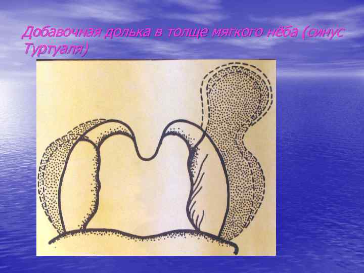 Добавочная долька в толще мягкого нёба (синус Туртуаля) 