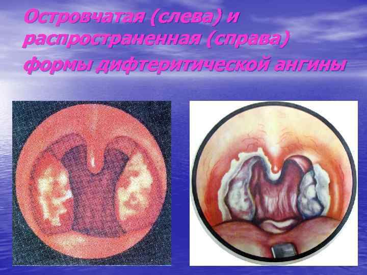 Островчатая (слева) и распространенная (справа) формы дифтеритической ангины 