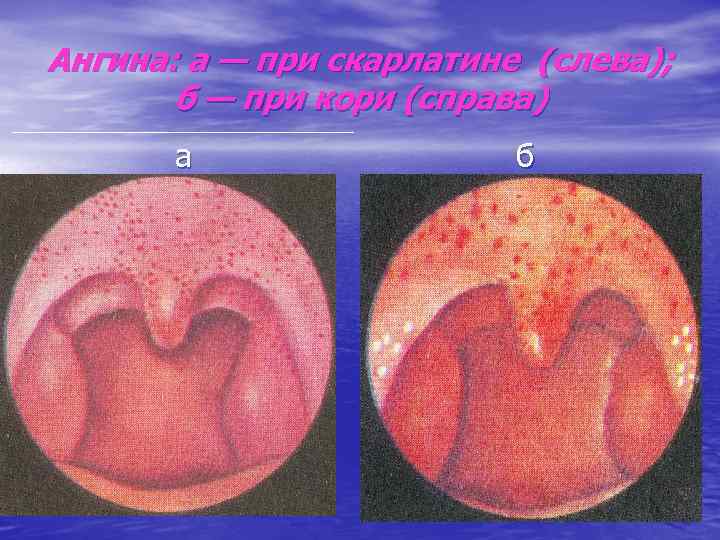 Ангина: а — при скарлатине (слева); б — при кори (справа) а б 