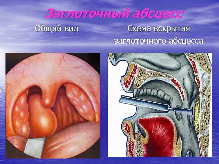Заглоточный абсцесс Общий вид Схема вскрытия заглоточного абсцесса 