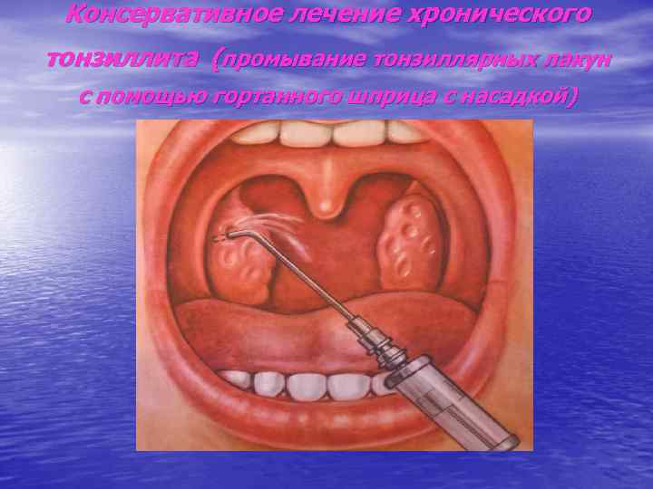 Консервативное лечение хронического тонзиллита (промывание тонзиллярных лакун с помощью гортанного шприца с насадкой) 
