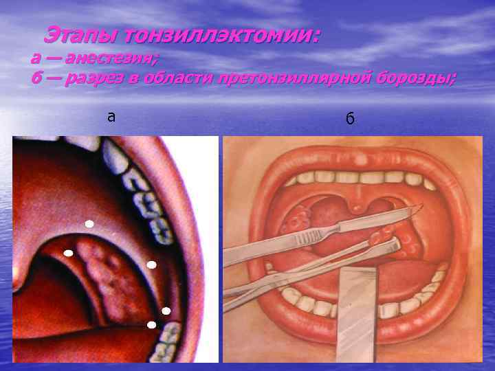 Этапы тонзиллэктомии: а — анестезия; б — разрез в области претонзиллярной борозды; а б