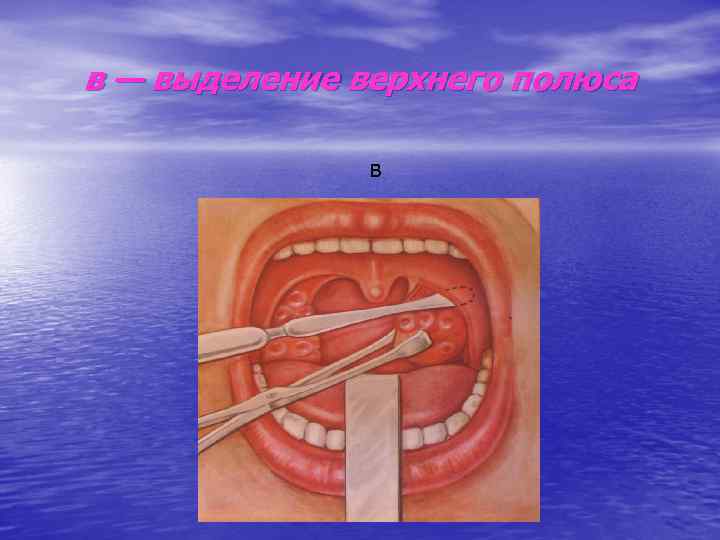 в — выделение верхнего полюса в 