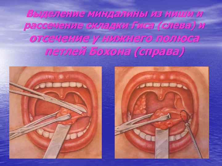 Выделение миндалины из ниши и рассечение складки Гиса (слева) и отсечение у нижнего полюса
