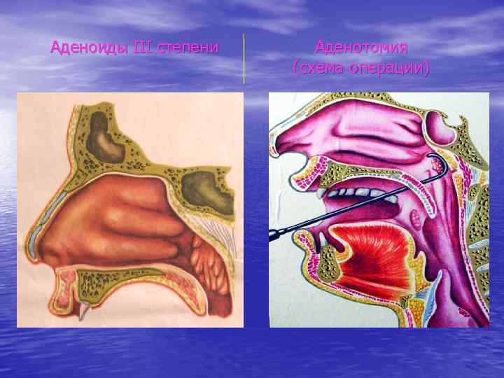 Аденоиды III степени Аденотомия (схема операции) 