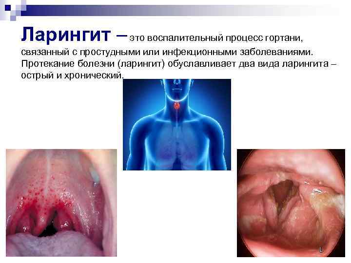 Ларингит – это воспалительный процесс гортани, связанный с простудными или инфекционными заболеваниями. Протекание болезни