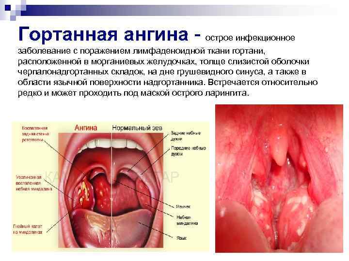 Гортанная ангина - острое инфекционное заболевание с поражением лимфаденоидной ткани гортани, расположенной в морганиевых