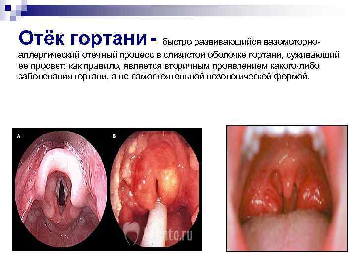 Отёк гортани - быстро развивающийся вазомоторноаллергический отечный процесс в слизистой оболочке гортани, суживающий ее