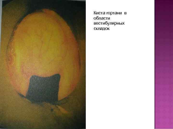 Киста гортани в области вестибулярных складок 