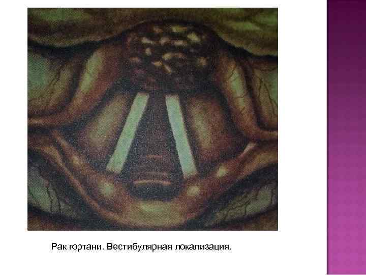 Рак гортани. Вестибулярная локализация. 