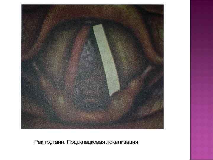 Рак гортани. Подскладковая локализация. 