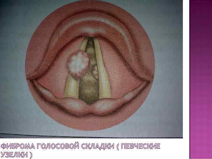 ФИБРОМА ГОЛОСОВОЙ СКЛАДКИ ( ПЕВЧЕСКИЕ УЗЕЛКИ ) 