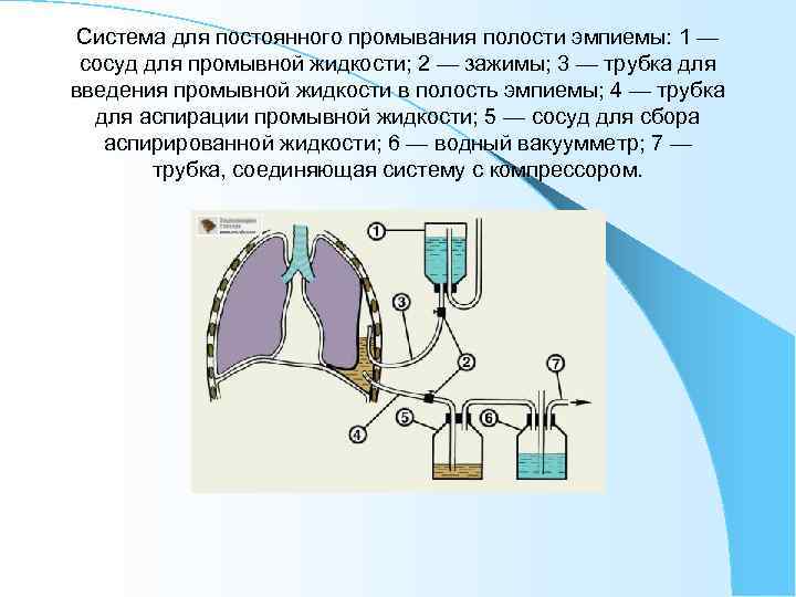 Система для постоянного промывания полости эмпиемы: 1 — сосуд для промывной жидкости; 2 —