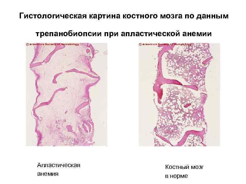 Гистологическая картина костного мозга по данным трепанобиопсии при апластической анемии Апластическая анемия Костный мозг