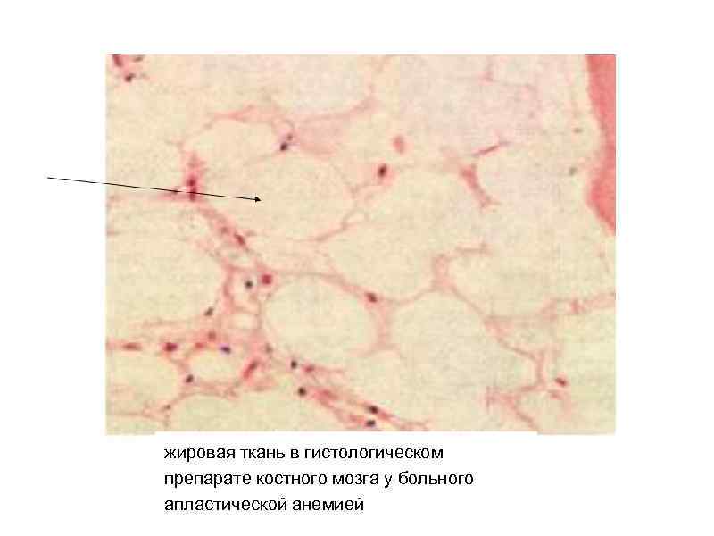 жировая ткань в гистологическом препарате костного мозга у больного апластической анемией 