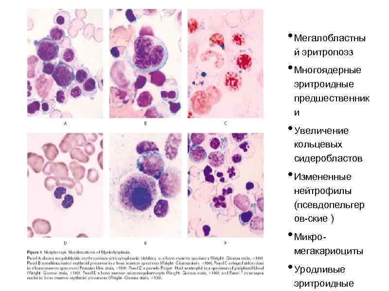  • Мегалобластны й эритропоэз • Многоядерные эритроидные предшественник и • Увеличение кольцевых сидеробластов