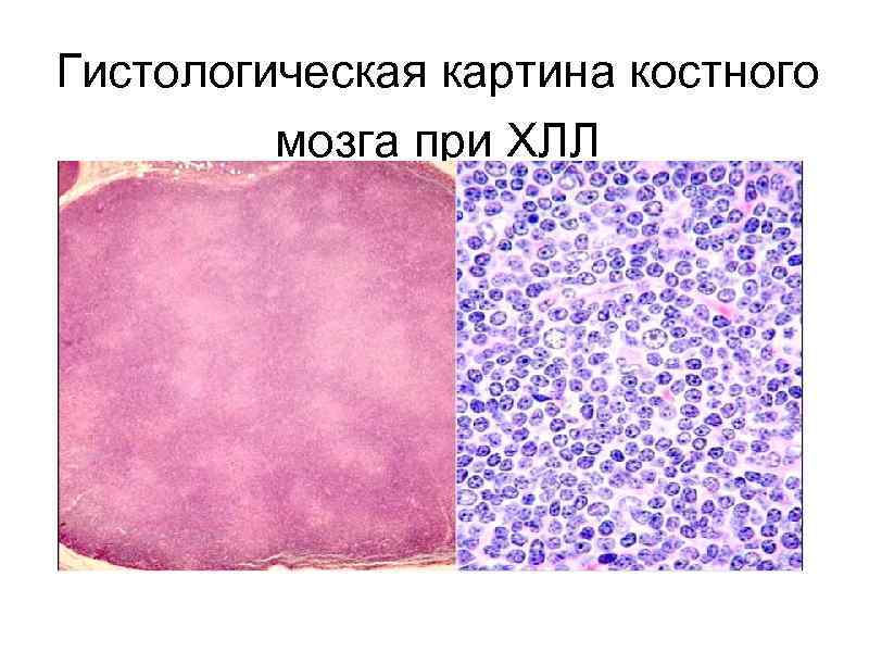 Гистологическая картина костного мозга при ХЛЛ 