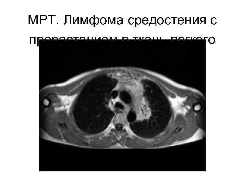 МРТ. Лимфома средостения с прорастанием в ткань легкого 