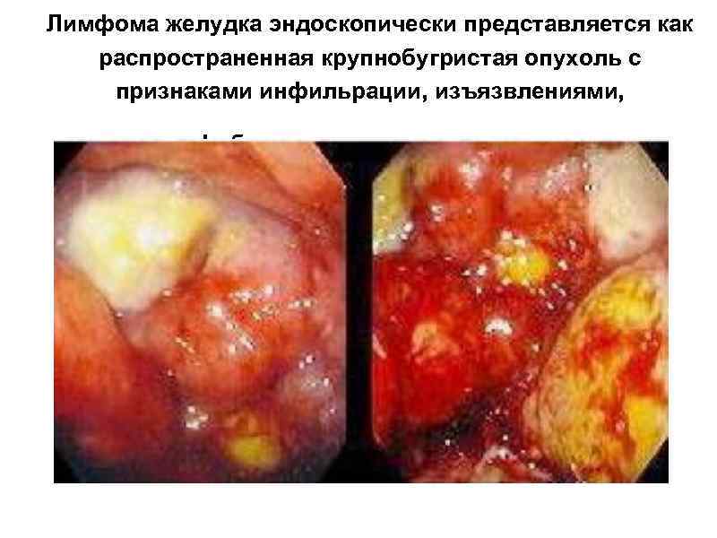 Лимфома желудка эндоскопически представляется как распространенная крупнобугристая опухоль с признаками инфильрации, изъязвлениями, фибринозными наложениями