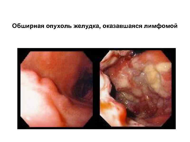 Обширная опухоль желудка, оказавшаяся лимфомой 