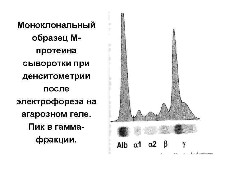 Моноклональный образец Мпротеина сыворотки при денситометрии после электрофореза на агарозном геле. Пик в гаммафракции.
